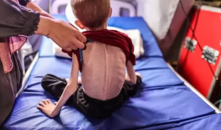 "أونروا":‏واحد من كل خمسة أطفال في غزة يعاني الآن من سوء التغذية